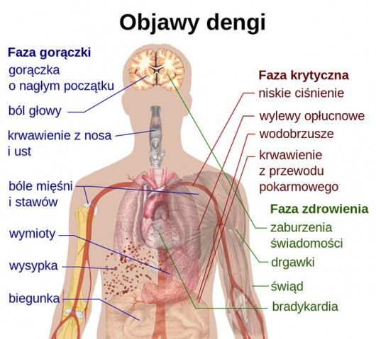 Objawy Kliniczne Gor Czki Denga